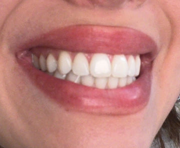 Close-up of a person's mouth with a focus on teeth.