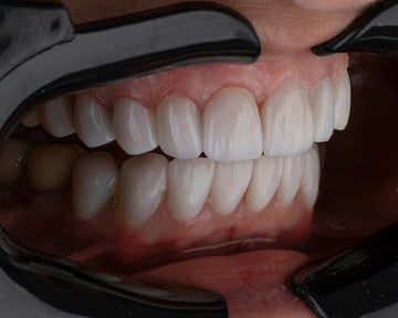 Close-up of a person's mouth with dental crowns on teeth
