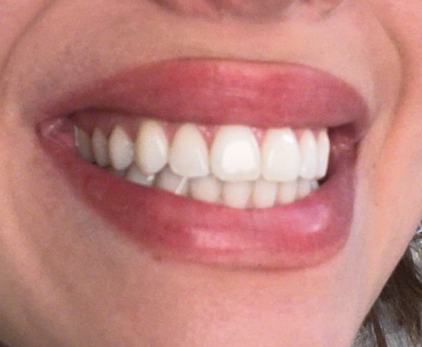 Close-up of a person's mouth with a focus on teeth.